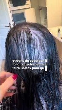 Androgenetic alopecia: 1-week treatment update #alopecia #hairloss
