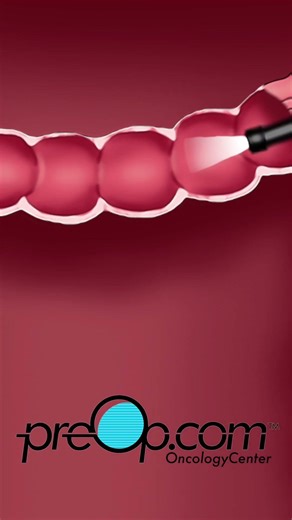 PreOp® Colonoscopy Explained | Prep, Procedure, and Recovery