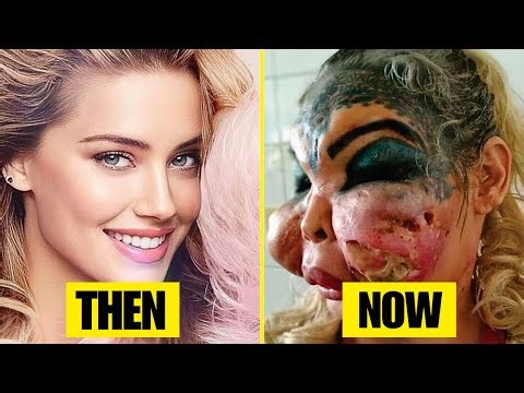 10 Famous Celebrities Unrecognizable After Plastic Surgery Gone Wrong | Then and Now 2025