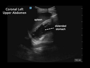 Gastric Distention - intractable nausea and vomiting