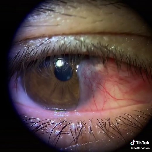 Surfer's Eye Treatment: How to Dissolve Pterygium | Eye Doctor Tips