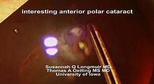 3.2K views · 96 reactions | Video demonstration of phacoemulsification cataract surgery in a case with anterior polar cataract. #OphthalmologyPearls | Ophthalmology Pearls | Facebook