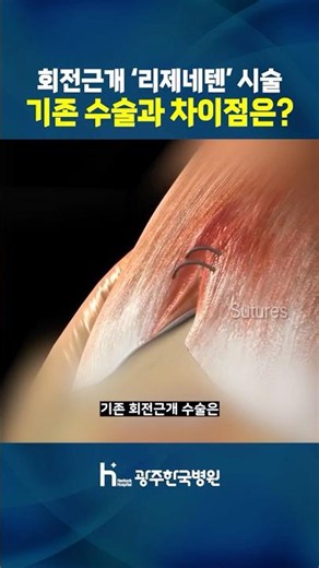 리제네텐 시술 vs 기존 봉합수술 ! 어떤 차이점이? #광주어깨수술 #회전근개수술 #광주정형외과