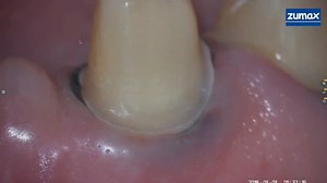 This video is from a post by Dr Yasir Al Twejry on our main group Zerodonto Dentistry IDS(immediate dentin sealing) 🅰️Immediate dentin sealing allows stress-free dentin bond development. 🅱️Immediate dentin sealing protects dentin against bacterial leakage and #sensitivity during provisionalization. | ZERODONTO