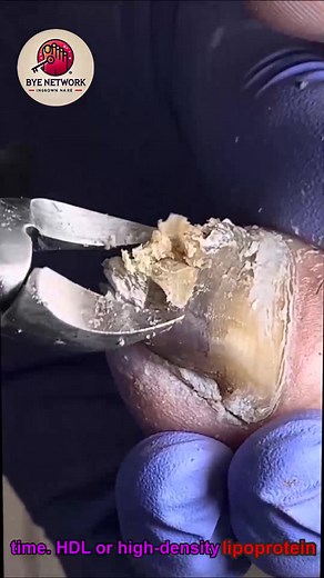 Tender nail bed advice without costly extra visits 🎀🎂 #NailFixTips #SafeNailCare #ToenailSupport | Bye