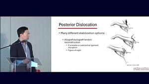 Sternoclavicular Joint Injuries: Management of the Acute Dislocation