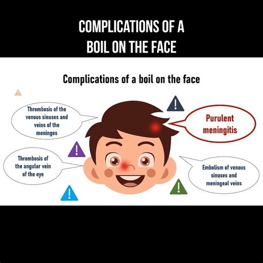 Complications of a boil on the face #boils #furuncle #skininfection #foliculite