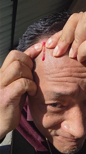 Got a painful boil (abscess) on your head? Here’s what to do🤣🤣