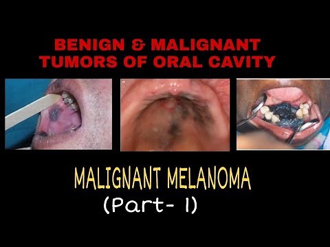 MALIGNANT MELANOMA - ( PART - 1 )