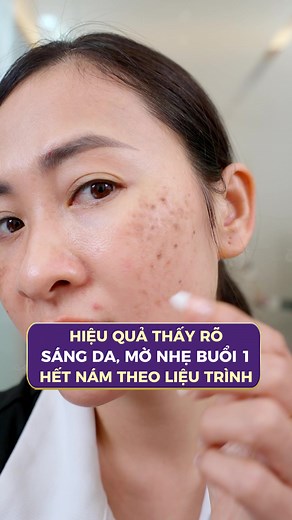 Hiệu quả mờ nám chỉ sau 1 liệu trình CẤY COLLAGEN. ƯU ĐÃI GIẢM 65% cho 5 suất đăng ký sớm nhất #thammylinhanh #lamdep #trehoada #dacangbong #namda #caycollagen #collagen