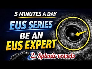 Splenic Vessel Navigation in EUS: Scope Techniques & Doppler Differentiation