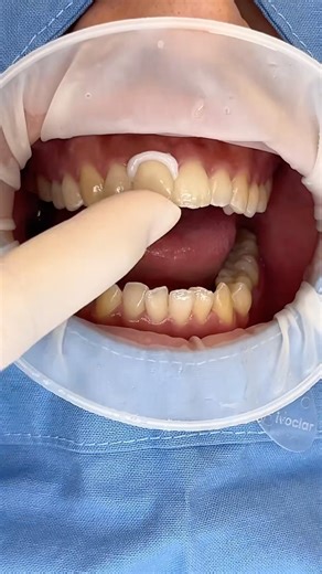 Ceramic crown setting process #Harue Dental Clinic #dentist #dental #Harue Dental Clinic