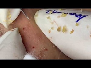Pimple popper and blackheads removal (252) | Loan Nguyen