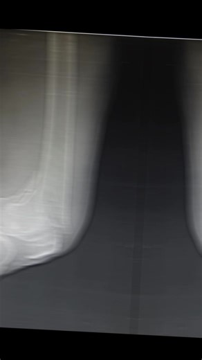 Successful Surgery for Distal Femur Fracture in Elderly