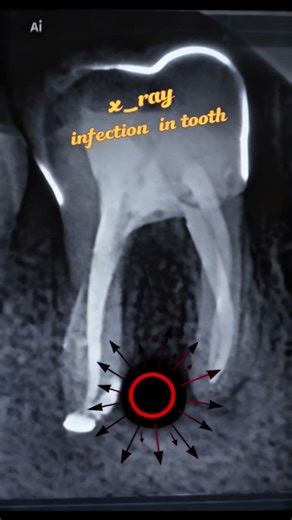 How dentists fix infected teeth #dentist #satisfying #asmr