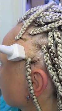 How to use a derma roller on your scalp edges // bald patches // FFA CCCA