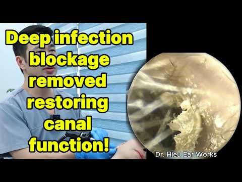 Deep infection blockage removed restoring canal fu | ear cleaning | ASMR earwax | soothing |relax|