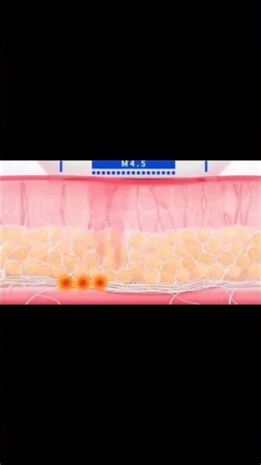 How HIFU Treatment Works | Non-Surgical Skin Tightening | Newderma Aesthetic Clinic