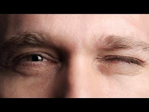 #bfs #twitch Big Muscle Twitching Benign Fasiculation Syndrome