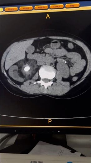 Kidney Stone Causing Hydronephrosis | Obstructive Uropathy CT #shorts