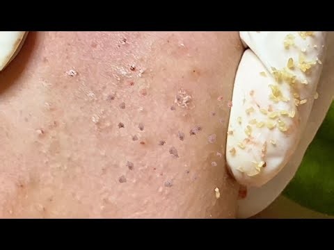 Deep Keratin Plug Removal and Closed Comedone Extraction Part 2| Spa Linh Mun #43
