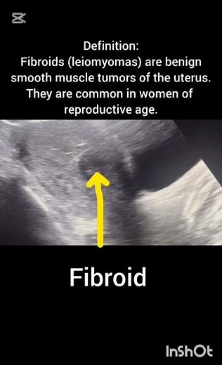 Pelvic Ultrasound showing Fibroid Uterus! Fibroid Uterus scan! #ultrasoundmadeeasy86#radiology#viral