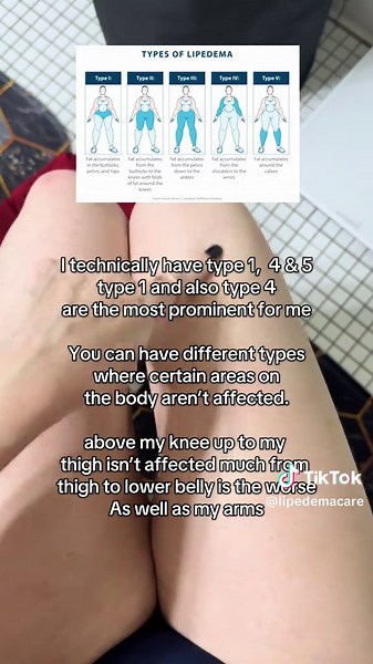 Understanding the Different Types of Lipedema