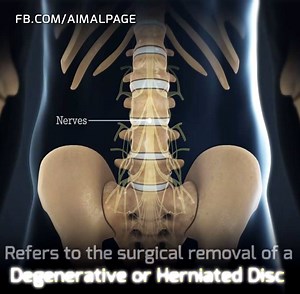 9.2K views · 23 reactions | Fusion surgery is designed to remove the intervening degenerative or herniated disc and allow two bones to fuse solidly into a single segment. | Natural Cures | Facebook