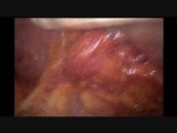 Minimally Invasive Donor Nephrectomy For Transplantation – Review Of Surgical Management • Video • MEDtube.net