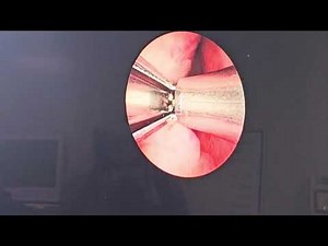 UROLIFT procedure by Dr Ashish Saini