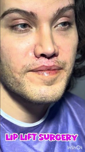 Central Lip Lift Surgery: Recovery Timeline, Aftercare & Results