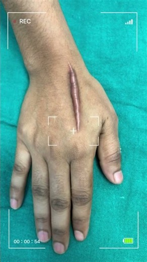 Can CO2 Laser Treat a Keloid? 😳