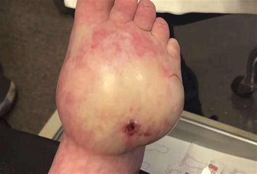 Super Seroma on Foot Drained