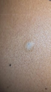 4.8M views · 8K reactions | Sebaceous cyst | Dr Khaled's Tumour Helpline | Facebook