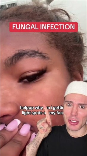 HOW TO GET RID OF WHITE SPOTS!😱 #skincareroutine #skincaretips #skincareproducts #skin
