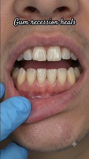 From Receding Gums to Healthy Smile | Dental Repair Animation #healthygums #gumcare