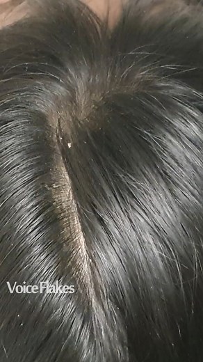 Dandruff scratching ASMR Soft Comb #2019 | Voice Flakes