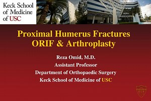 Proximal Humerus Fractures ORIF &amp; Arthroplasty - SlideServe