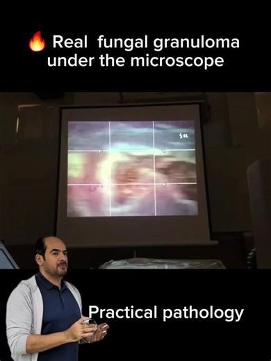 🔥 Real fungal granuloma #medicalstudent #fyp #باثولوجي #granuloma #pathology