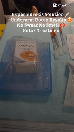 Flawless Aesthetics – Hair, Skin & Body Experts on Instagram: "Say goodbye to underarm sweating 👋 Underarm Botox is a safe & pain-free treatment 💉✨ ✅ Benefits: ✔ Reduces excessive sweating ✔ Controls odor ✔ Boosts confidence ✔ Quick procedure, no downtime 📩 Book your Botox today DM / WhatsApp for appointment #UnderarmBotox #NoMoreSweat #Hyperhidrosis #BotoxTreatment #SweatFree AestheticClinic ConfidenceBoost SkinCare"