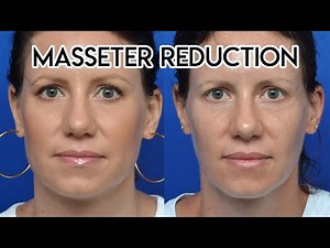 Masseter Reduction