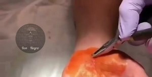 Blood spews from removing nail stuck in hand