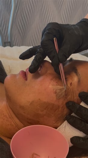 Advanced Esthetician LV | Christina on Instagram: "The Elaine Brennan Skin Renewal Peel helps: ✔️ Improve active breakouts ✔️ Smooth uneven texture ✔️ Soften the look of acne scars ✔️ Brighten and renew dull skin Results are cumulative, with best improvements often seen over 2–3 treatments and continued annual maintenance peels. Real results. Real skin renewal. This client has had two treatments, and is very happy with her results. Acne scars don’t have to be your forever, let’s curate a customi
