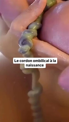 Avez-vous déjà entendu parler du clampage tardif ? C’est le fait d’attendre avant de couper le cordon ombilical pour que le sang, riche en globules rouges, fer et cellules souches, ait le temps de passer du placenta au bébé. 💪 Comme on le voit sur la vidéo, à la naissance, le cordon est encore plein de sang 🔄. Mais si on attend un peu, il devient blanc : cela signifie que bébé a récupéré tout le sang qui lui revenait. ❤️ 👉 Un geste simple, aux nombreux bienfaits prouvés scientifiquement ! (Il