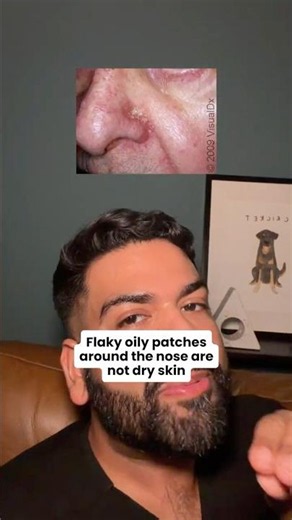 Flaky patches around your nose that won't respond to moisturizer?