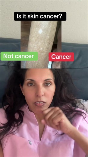 Is it skin cancer or not? Scc, idiopathic guttate hypomelanosis , bcc #skincancer #bcc #scc