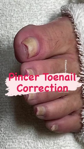 36K views · 60 reactions | Problems with Pincer Nails? We can help with the proper tools and nail education courses at meticulousmanicurist.com! | The Meticulous Manicurist Nail Tutorials | Facebook