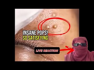 10 Minutes of Deep Pimple Pops & Blackhead Extractions | The Most Satisfying Compilation Ever! 😊