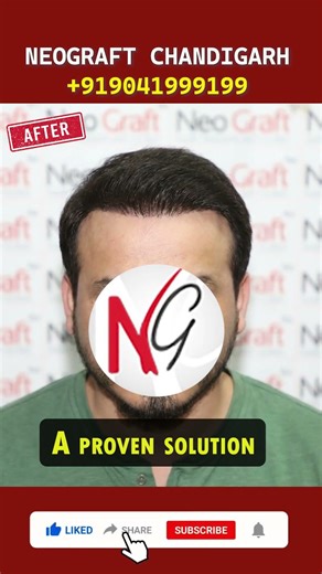Is Hair Transplant Worth It? See the Result | #neograft #Hairtransplant #Hairrestoration