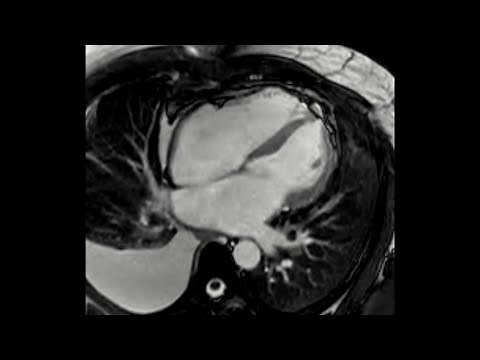 Cardiac Magnetic Resonance Showing Signs of Constrictive Physiology